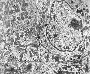 M,47y. | chromophobic pituitary adenoma